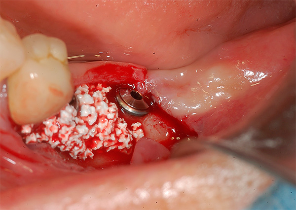 The photo shows an example of implantation with simultaneous bone grafting.