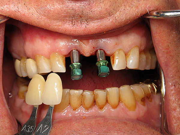 Parodontitis en parodontitis veroorzaken een aantal problemen voor tandheelkundige implantaten, maar niet alles is zo hopeloos als het op het eerste gezicht lijkt ...