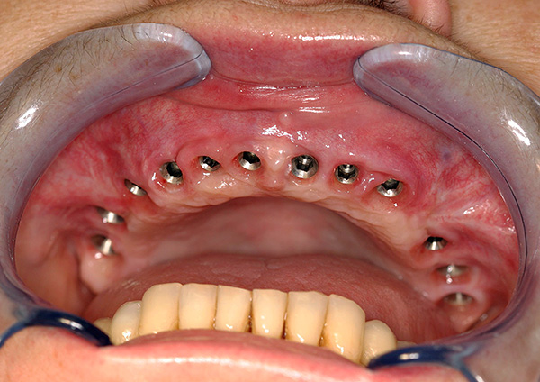 Nadat alle tanden zijn verwijderd, kan implantatie worden uitgevoerd.