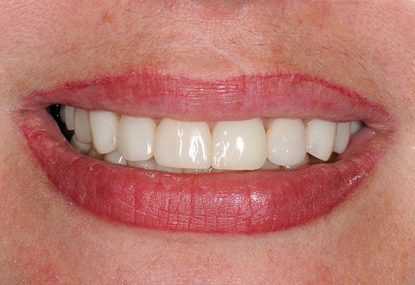 Tüm hastaların ve eksik dişlerin implantlarla değiştirilmesinin sonucu güzel, eşit bir gülümseme ve normal çiğneme yeteneğidir.