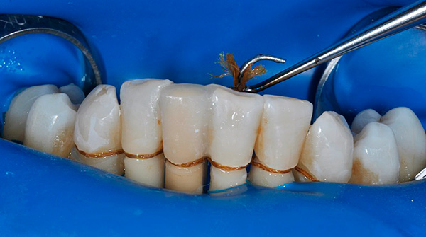 A foto mostra um exemplo de tala de dentes com fio dental especial.