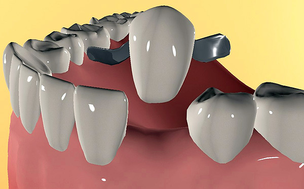 Kahit na pagkatapos ng paggamot para sa periodontitis, may panganib na ang mga ngipin ay magiging mobile at hindi na magagawang hawakan ang tulay.