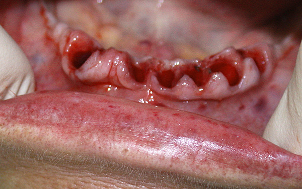 W ciężkich postaciach zapalenia przyzębia często wykonuje się wielokrotne ekstrakcje zębów (wówczas implanty można zastąpić na ich miejscu).