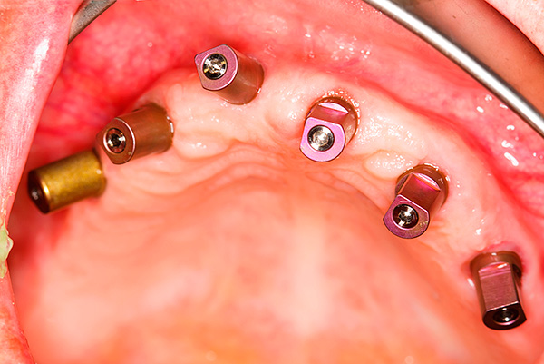Ofte under periodontal sygdom udføres en komplet tandekstraktion med samtidig installation af implantater.