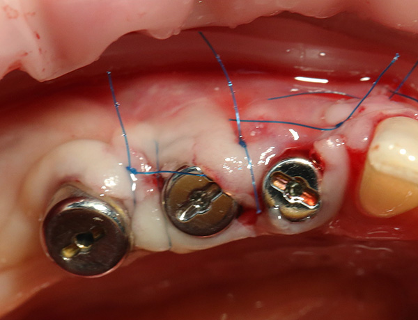 The absence of foci of inflammation in the area of ​​installed implants significantly reduces the risk of rejection.