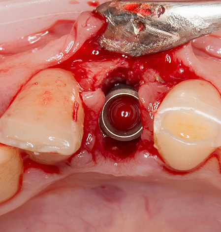 Com periodontite e doença periodontal, o implante de um estágio pode ser realizado imediatamente após a extração do dente.