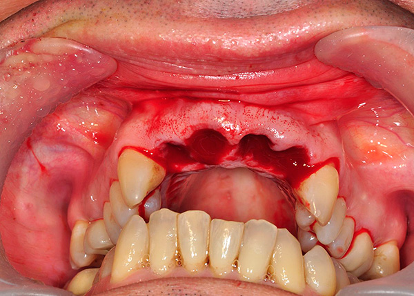 Ví dụ, cấy ghép cơ bản có thể được đặt ngay sau khi nhổ răng.
