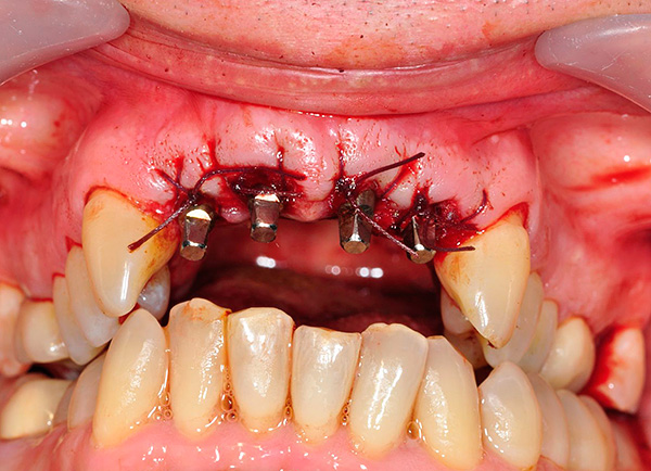 A foto mostra um exemplo de implante basal instalado na mandíbula superior.