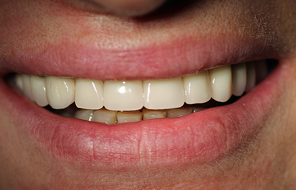 O cuidado adequado dos implantes permite prolongar sua vida útil, o que é especialmente importante com periodontite persistente (doença periodontal).