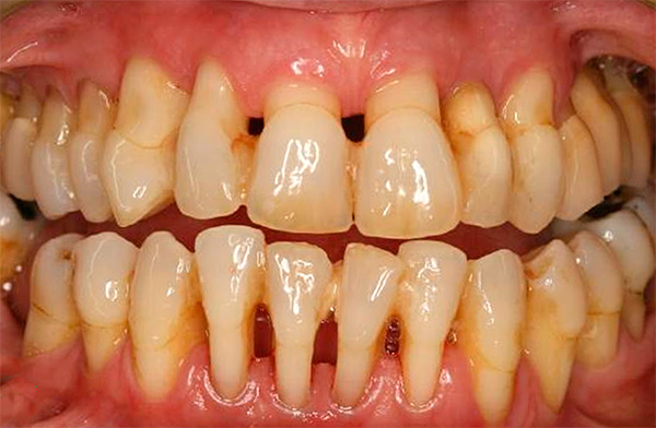 Ve burada periodontal hastalık