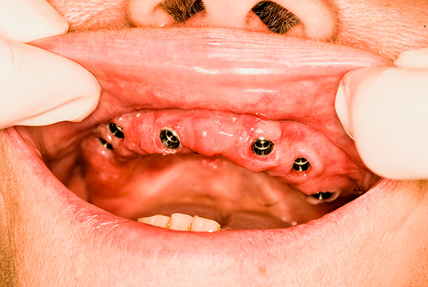 Anche se la condizione dei denti è molto scarsa, l'impianto spesso consente di ripristinare la bellezza di un sorriso e la capacità di masticare il cibo normalmente.