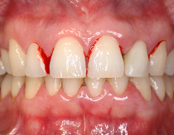 Diş eti iltihabı periodontitin öncüsüdür - bu aşamada, diş etlerinin artan kanaması zaten görülebilir ...