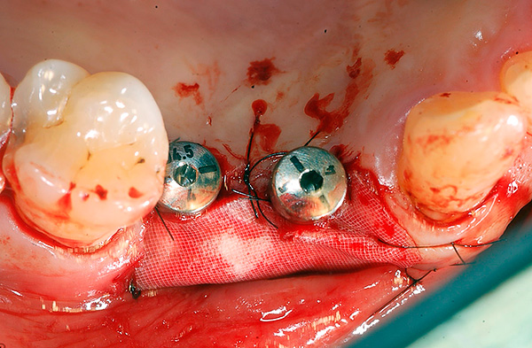Oikea-aikainen implantaatio todella pystyy pysäyttämään luun menetyksen poistamalla tartunnan keskittymän ja luomiseen pureskeltavan kuorman.