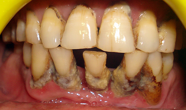 Bij ernstige vormen van parodontitis moeten alle tanden worden verwijderd.