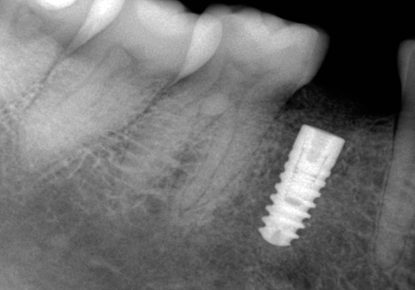 Cerrahi olmayan implantasyonda bile, diş etlerine en az zarar vermesine rağmen, içine bir implant takmak için çene kemiğini delmeniz gerekeceğini unutmayın.