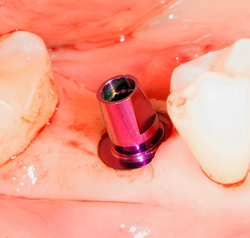 Deși publicitatea poate vorbi despre o metodă non-chirurgicală de plasare a implantului, în realitate, operația are loc în continuare.
