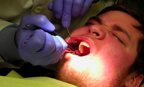 Pokud extrakce zubu neběží zcela hladce, může se lékař rozhodnout odmítnout současnou instalaci implantátu.