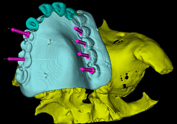 Die 3D-Modellierung bei Zahnimplantaten kann die Wahrscheinlichkeit von medizinischen Fehlern erheblich verringern.