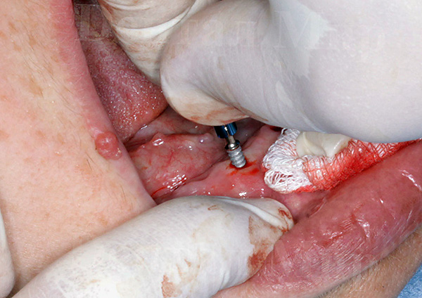 Fotot visar ett exempel på implantatplacering i käken.