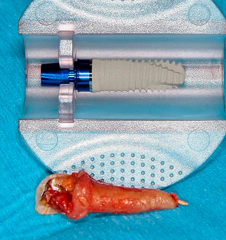 Tijdens een snelle implantatie wordt een tandheelkundig implantaat onmiddellijk na de tandextractie in het gat ingebracht.