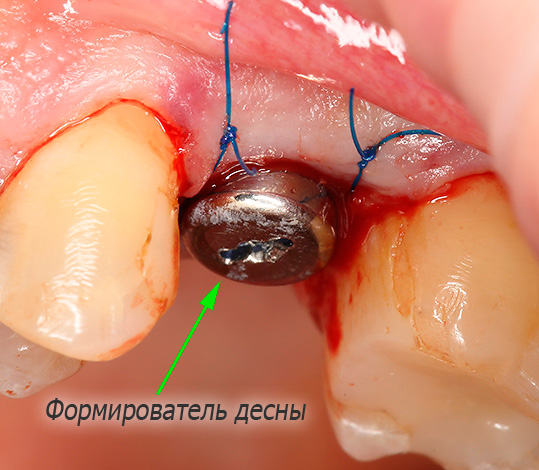 Op het nieuw geïnstalleerde implantaat wordt onmiddellijk een kauwgumvormer aangebracht.