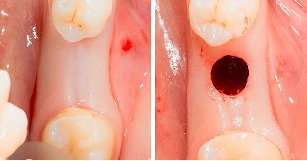 Pri tzv. Nechirurgickej implantácii zubov sa stále vykonáva rez ďasien - je jednoducho kruhový a nie pozdĺžny.