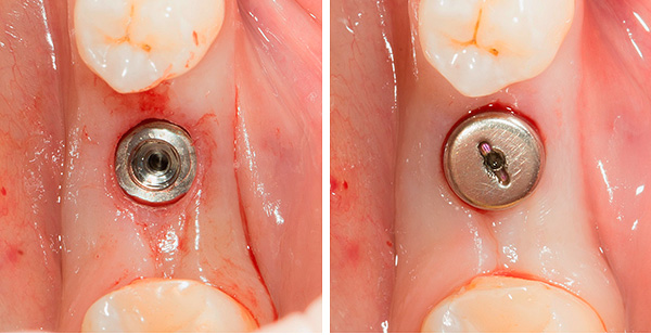 Po inštalácii implantátu sa naň umiestni guma.