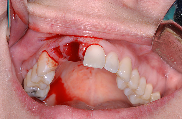 A fresh hole after tooth extraction is often quite suitable for installing an implant in it.