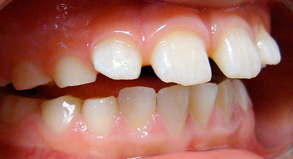 Amb una picada oberta, es forma un buit sagital entre les dents.
