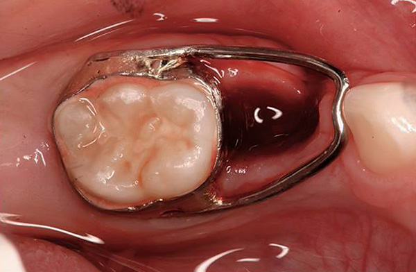 La foto muestra un ejemplo de un dispositivo que guarda un lugar en la dentición para la erupción de un diente permanente.