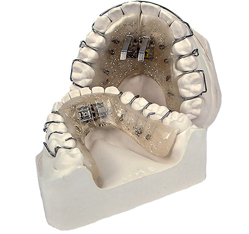 Máquina de tornillo extraíble para expandir y controlar el crecimiento de la mandíbula.