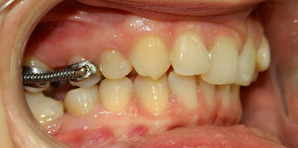 Al corregir una mordida distal, un sistema de soporte especial con la ayuda de resortes ayuda a mover los dientes superiores 6 y 7 a la posición posterior.
