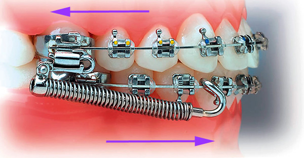 O variantă a aparatului Herbst - arcurile împing maxilarul inferior înainte, iar cel superior este deplasat înapoi.