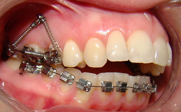 Esant atviram įkandimui, tarp dantų yra tarpas.