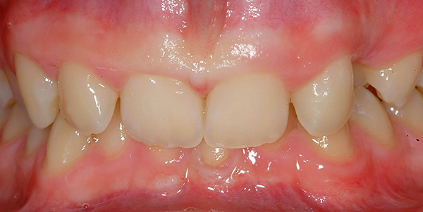 Su giliu distaliniu įkandimu, priekiniai dantys dažnai sužeidžia minkštuosius audinius - susidaro vadinamasis trauminis įkandimas.