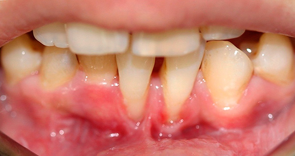 Zahnfleischrezession im Bereich der unteren Schneidezähne.