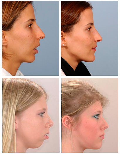 Zdjęcia pokazują, jak profil twarzy może wyglądać przed i po korekcji dystalnego zgryzu.