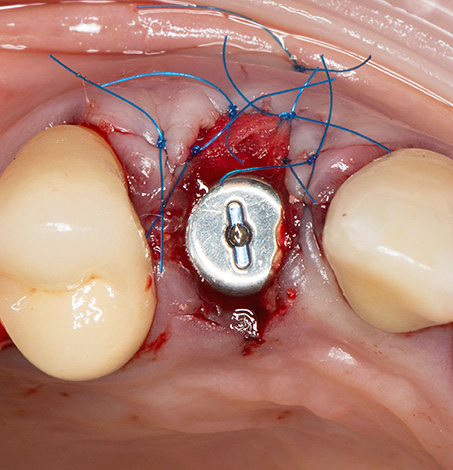 Given the certain invasiveness of the procedure, swelling and bleeding are indeed possible after implant placement.
