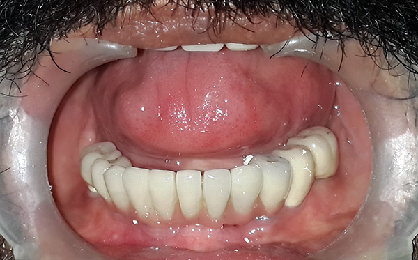 Un ejemplo de restauración de la dentición en implantes.