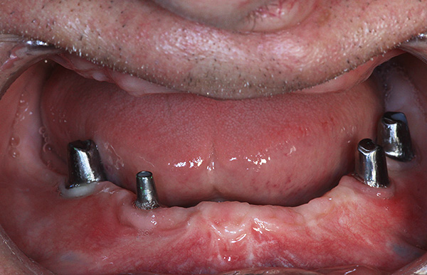 Zdjęcie pokazuje przykład odbudowy zębów na implantach w starszym wieku ...