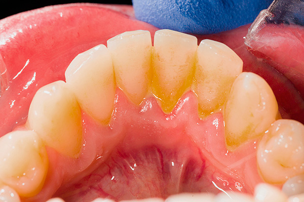 Špatná ústní hygiena může rychle vést k tvorbě hojných zubních usazenin (plak a zubní kámen).