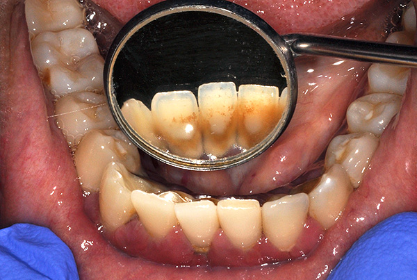 De opeenhoping van tandplak en steen in de toekomst kan leiden tot parodontitis en mobiliteit van niet alleen inheemse tanden, maar ook implantaten.