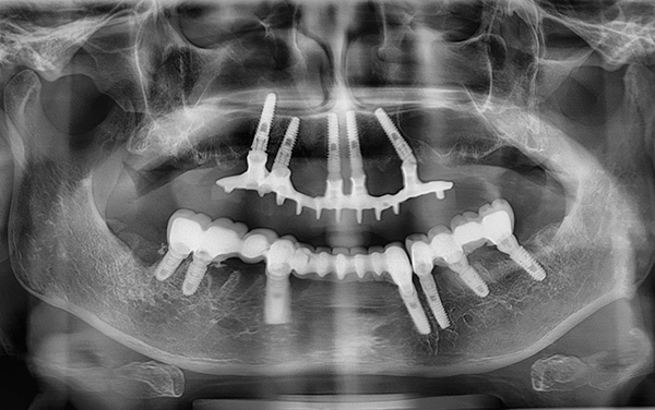 Retos gadījumos implants faktiski var sabojāt augšžokļa sinusa sienu.