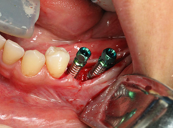Zoals u kunt zien, is implantatie inderdaad een nogal traumatische procedure en kunt u niet zonder anesthesie ...