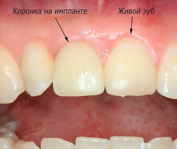 ในภาพนี้คุณสามารถเห็นผลลัพธ์ของขาเทียมของซี่ฟันหน้าบนรากเทียม XiVE
