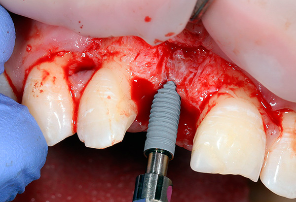 La photo montre l'installation de l'implant XiVE dans la mâchoire ...