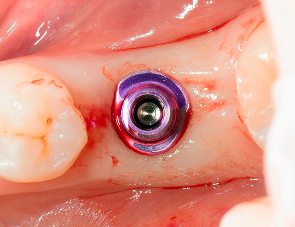 Valokuvassa on leukaan asetettu XiVE-implantti.