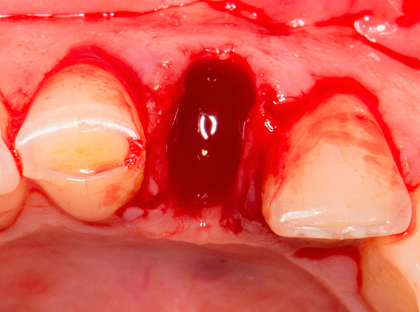V některých případech lze pomocí implantátů XiVE provést tzv. Okamžitou implantaci tak, že se umístí do dobře odstraněné jamky.