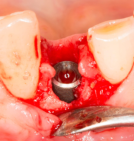 Имплантът се вкарва в отвора на извлечения зъб ...