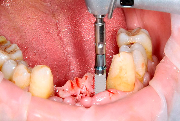 Le motif de filetage des implants XiVE les empêche de se coincer dans la mâchoire.